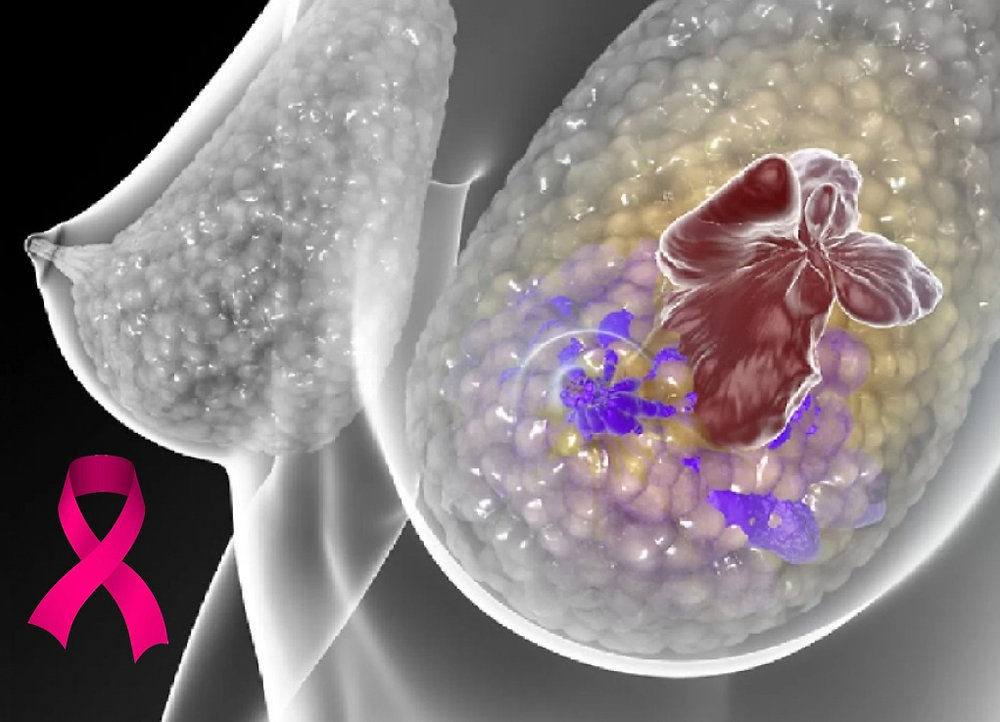 Estudo busca novas alternativas  para combater o câncer de mama triplo negativo