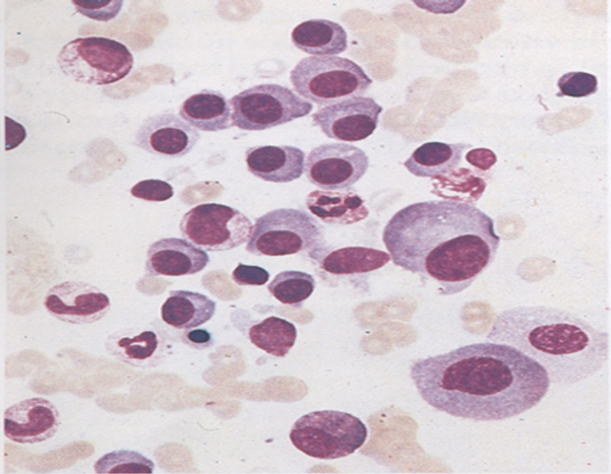 Novos horizontes para tratar o Mieloma Múltiplo no SUS